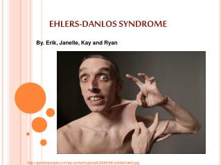  EHLERS-DANLOS SYNDROME 